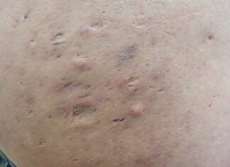 “이곳”근처에 뾰루지가 있다면…. 유심히 잘 관리해야됩니다.