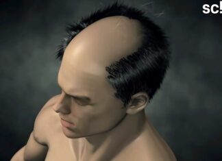 이 동네 사는 탈모 환자들, 정부 치료비 지원받으세요 탈모