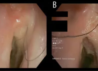 목구멍 안에서 5cm짜리 털이 자라는 남자, 무슨 병이길래?
