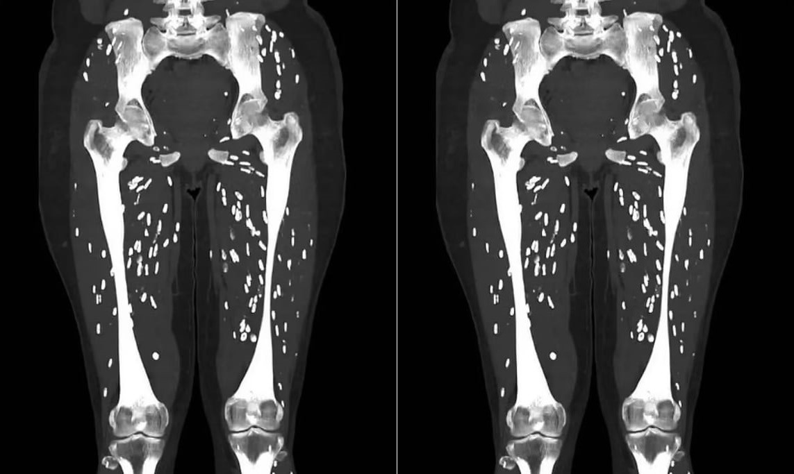 다리에 쌀알 모양 기생충 가득…덜 익은 돼지고기 먹고 찍은 CT