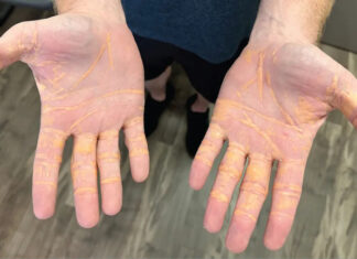 육류와 유제품만 8개월 먹은 남성의 건강은? 지방낀 손바닥