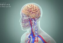 30대에 치매 진단받은 여성, 뒤늦게 밝혀진 진짜 원인은 치매